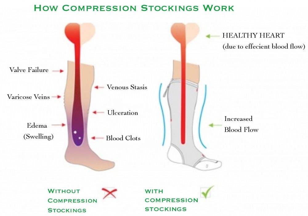 how compression socks work chart